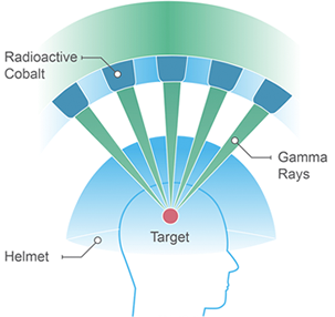 radiosurgery graphic